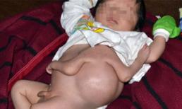 Em bé mới sinh ở Tây Ninh có bốn cánh tay